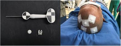 The Clinical Application of Robot-Assisted Ventriculoperitoneal Shunting in the Treatment of Hydrocephalus